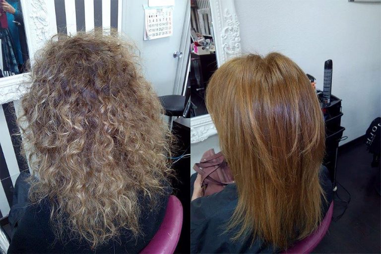 Antes y después del tratamiento de nanoplastia en melena